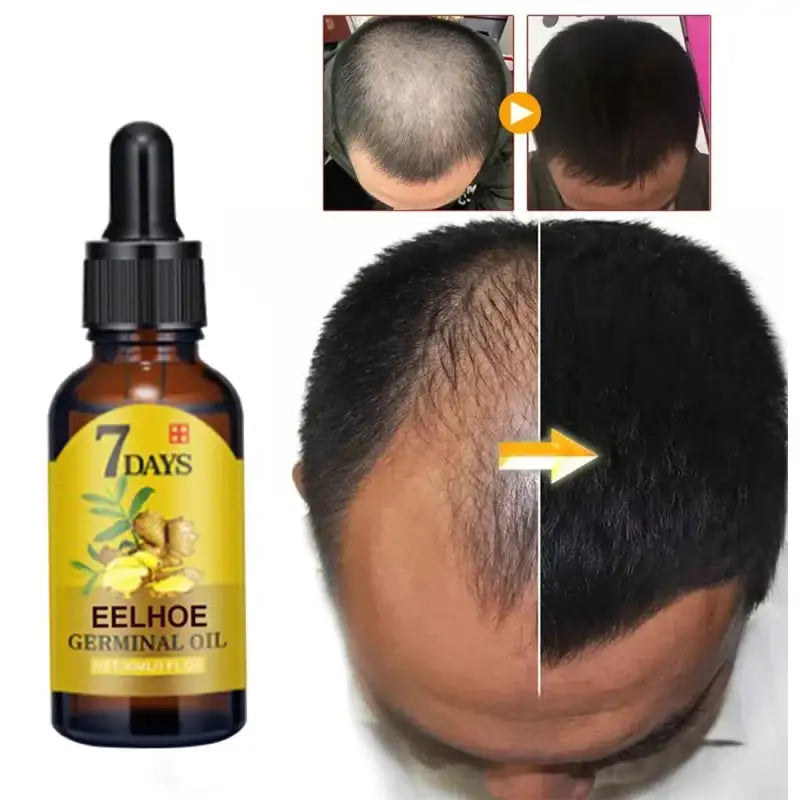 Sérum pour Pousse de Cheveux au Gingembre - Eelhoe-Sérum pour Cheveux-